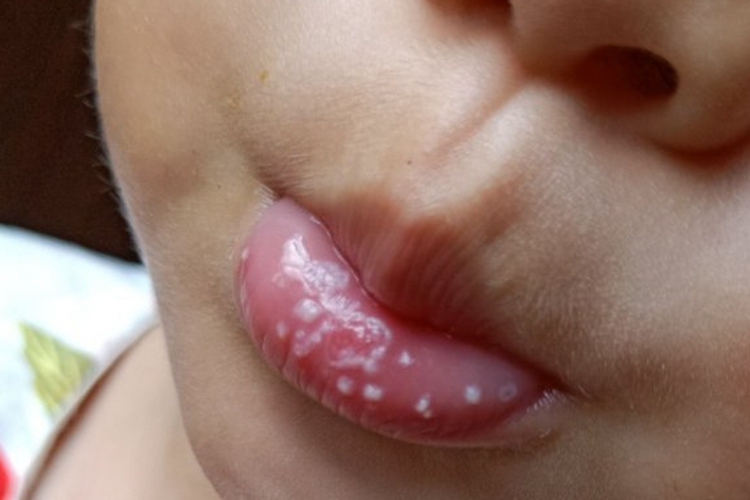 口腔单纯疱疹图