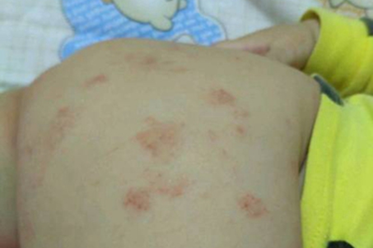 尿布皮炎一侧臀部红斑聚集图