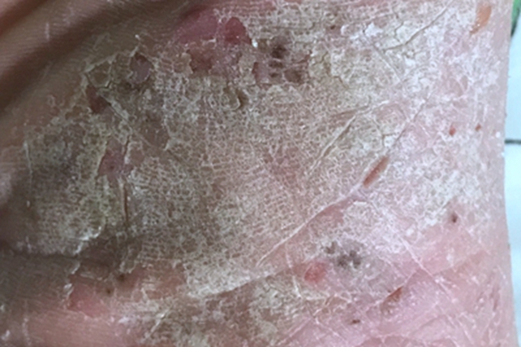 鳞屑角化型足癣脚底结痂图