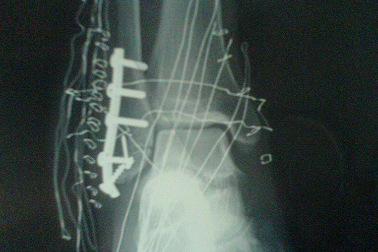 I型骨折钢钉固定图