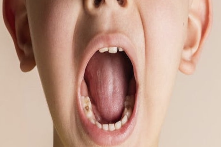 乳牙后牙浅龋图 乳牙后牙浅龋图