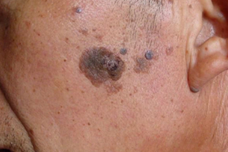 疣状脂溢性角化症斑图