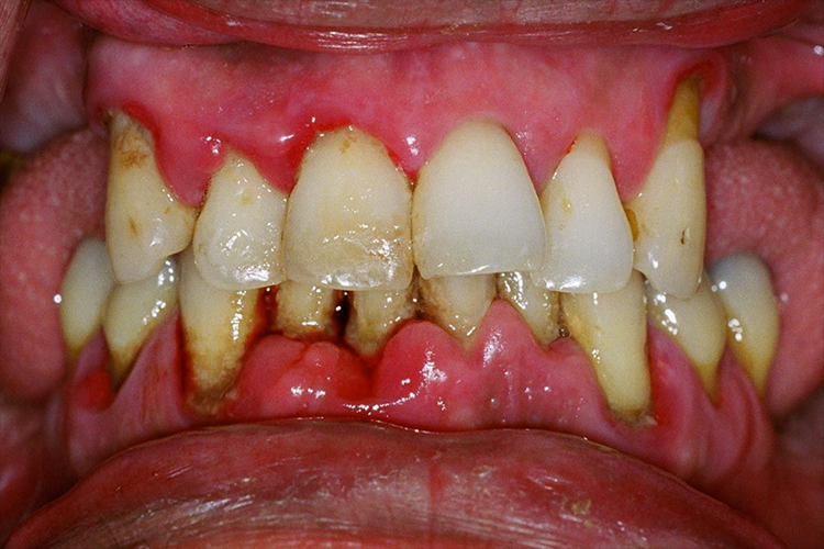 长期吸烟牙周红肿出血图