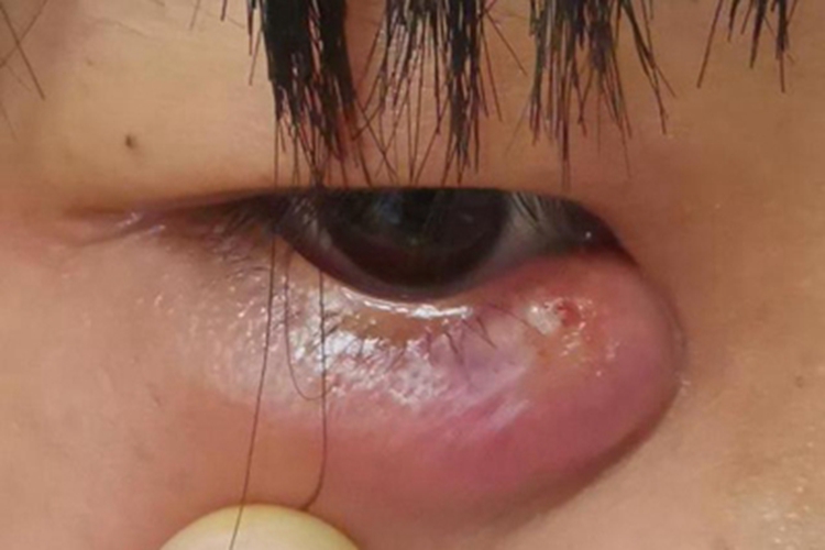 眼睑单纯性疱疹眼睑肿出现化脓图 眼睑单纯性疱疹眼睑肿出现化脓图