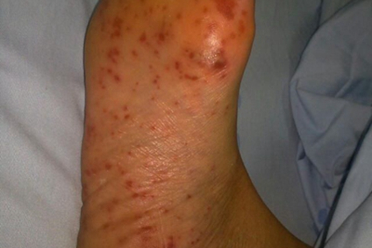 特发性血小板减少性紫癜红点图 特发性血小板减少性紫癜红点图