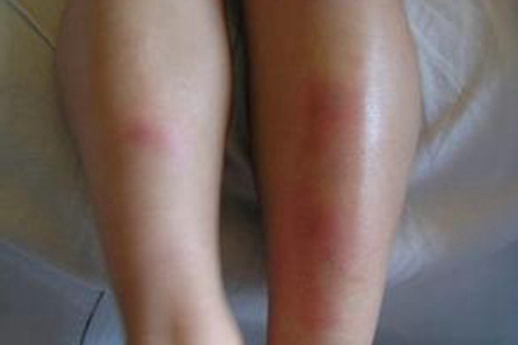 硬红斑小腿发红发肿图