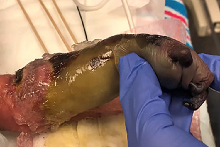 坏疽性蜂窝织炎胳膊坏死化脓图 坏疽性蜂窝织炎胳膊坏死化脓图