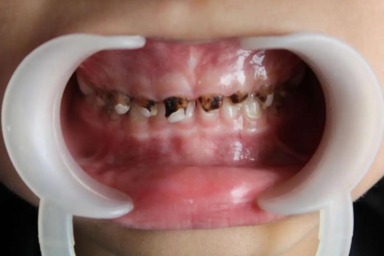 乳牙龋坏早失图