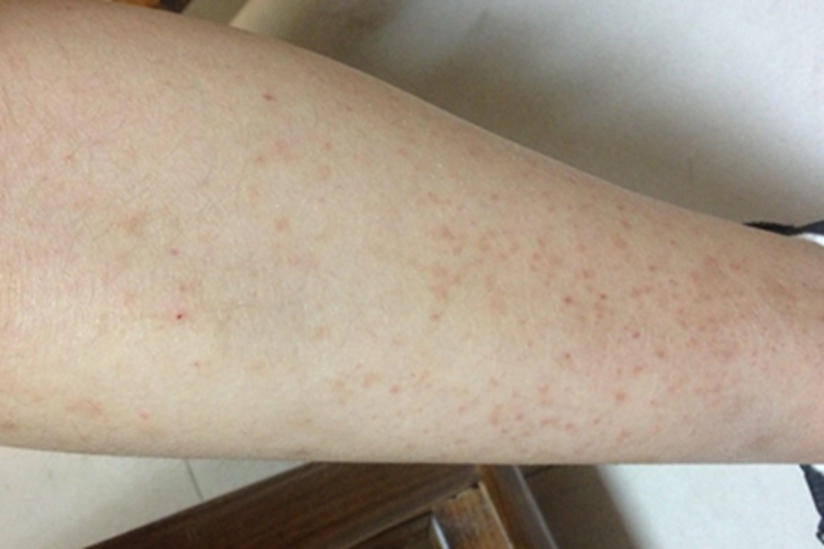 异常蛋白血症紫癜小腿斑图