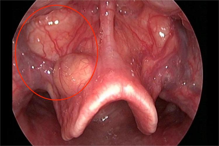 会厌舌面右侧囊肿图 会厌舌面右侧囊肿图