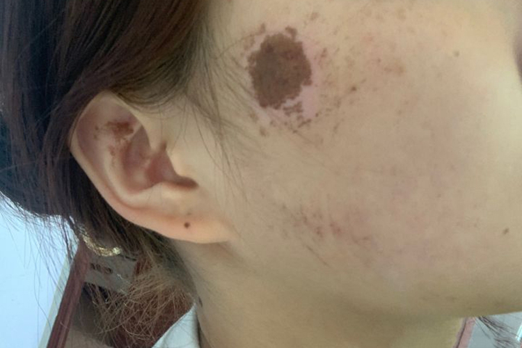 面部擦伤部分痂皮脱落图