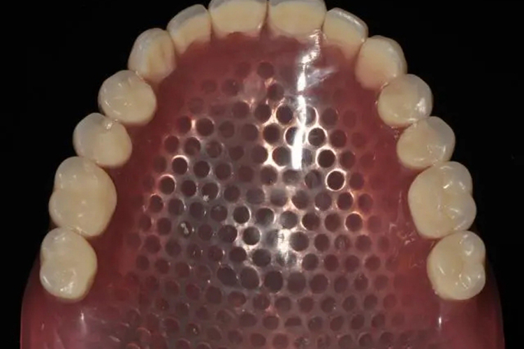 上颌半口可活动义齿图