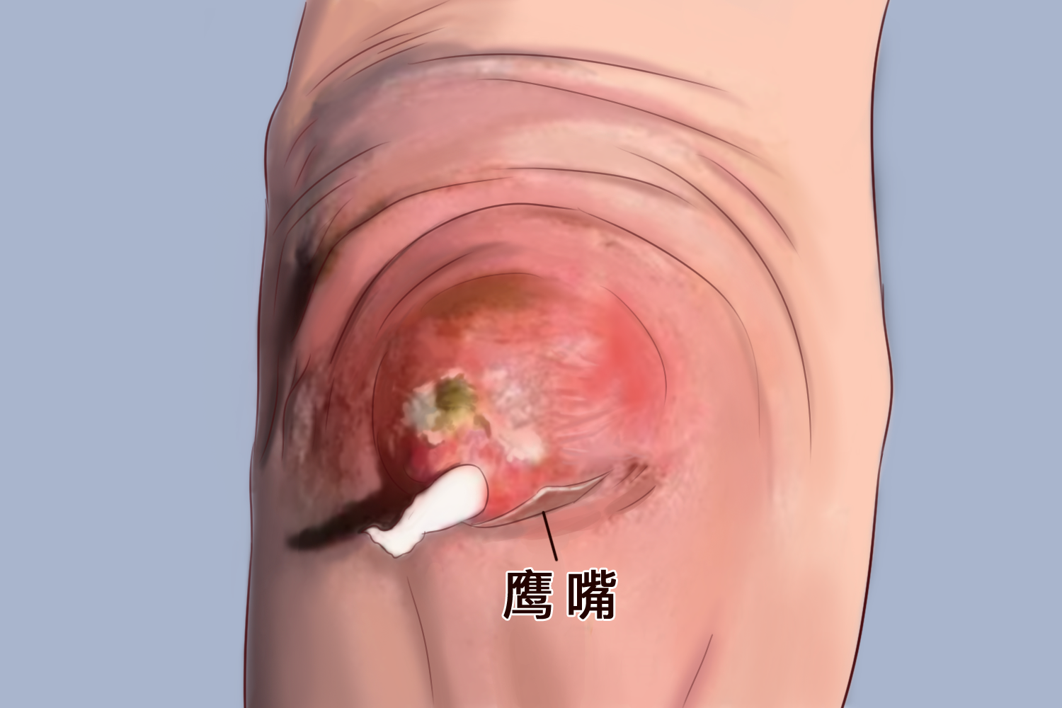 尺骨鹰嘴痛点示意图