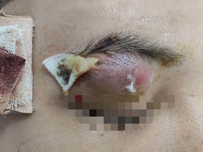 表皮样囊肿眉毛下边大红疙瘩化脓图