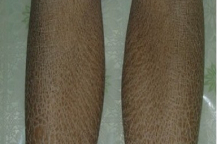 毛囊性鱼鳞病小腿斑图