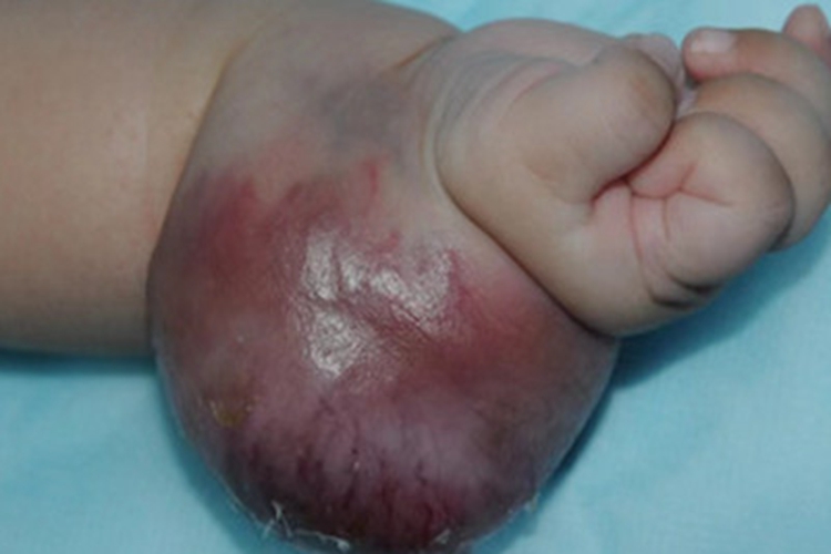 小儿型纤维肉瘤手腕肿块图