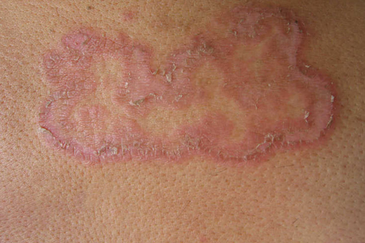 体癣大片红斑图