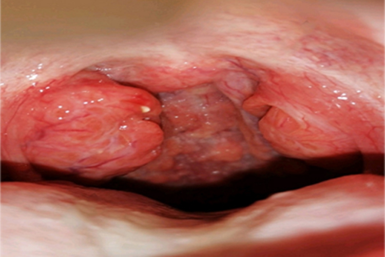 淋菌性咽炎化脓图