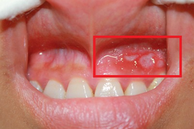 口腔溃疡为什么是白色的 口腔溃疡为什么是白色的