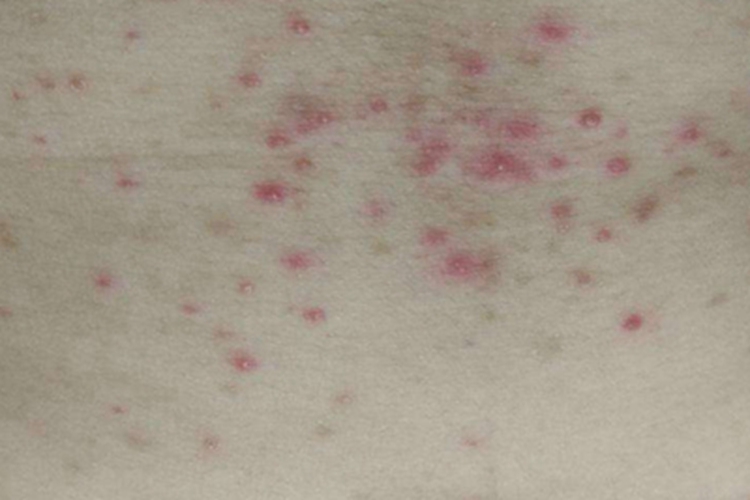 革螨皮炎上腹症状图