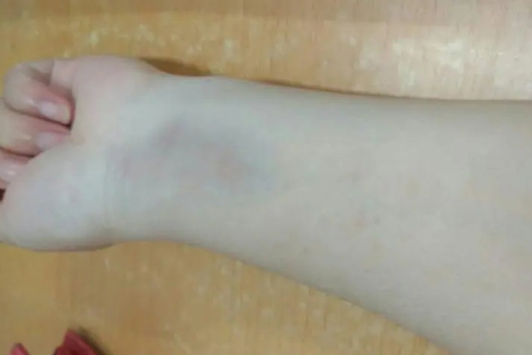 创伤手腕内侧淤青图 创伤手腕内侧淤青图