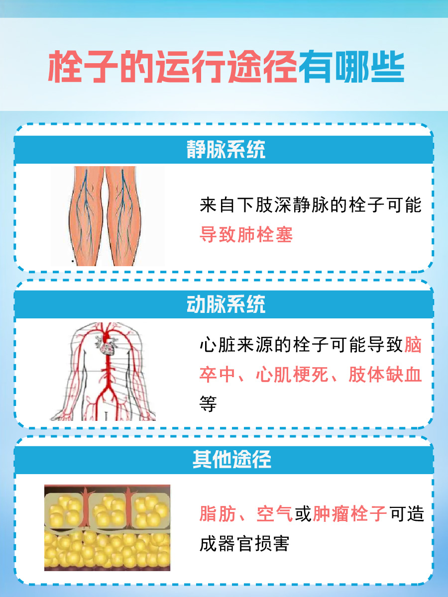 栓子运行路径？医生告诉你