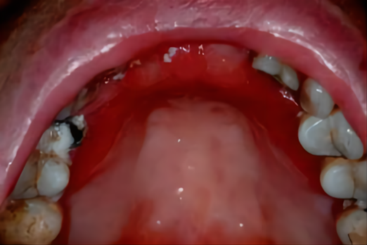 急性红斑型念珠菌性口炎图