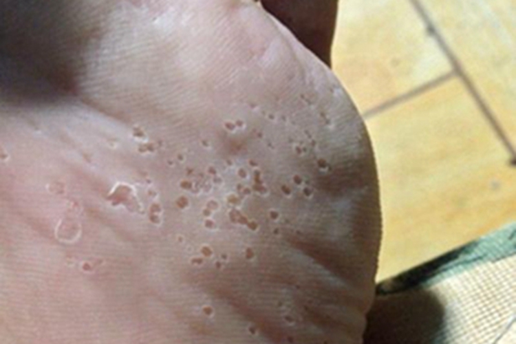 沟状跖部角质松解症脱皮图