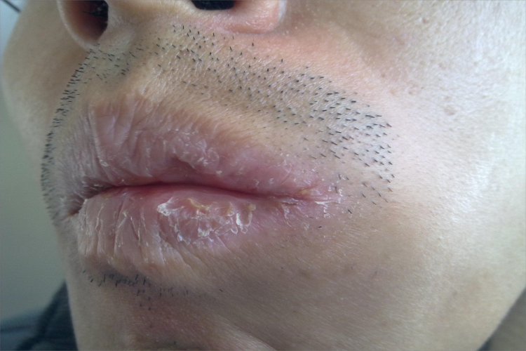 慢性光化性唇炎嘴唇脱屑图 慢性光化性唇炎嘴唇脱屑图