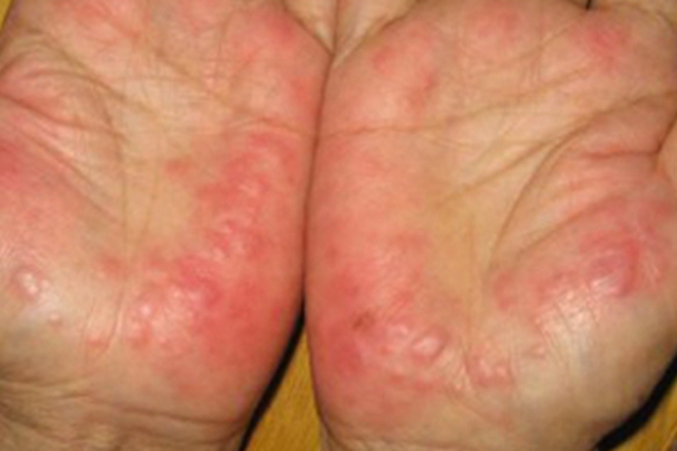 急性发热性嗜中性皮病手掌症状图