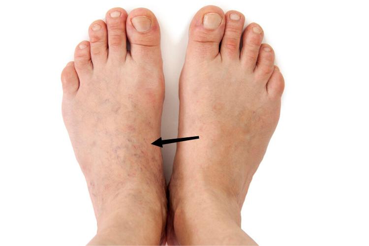 脚部静脉血栓轻症图