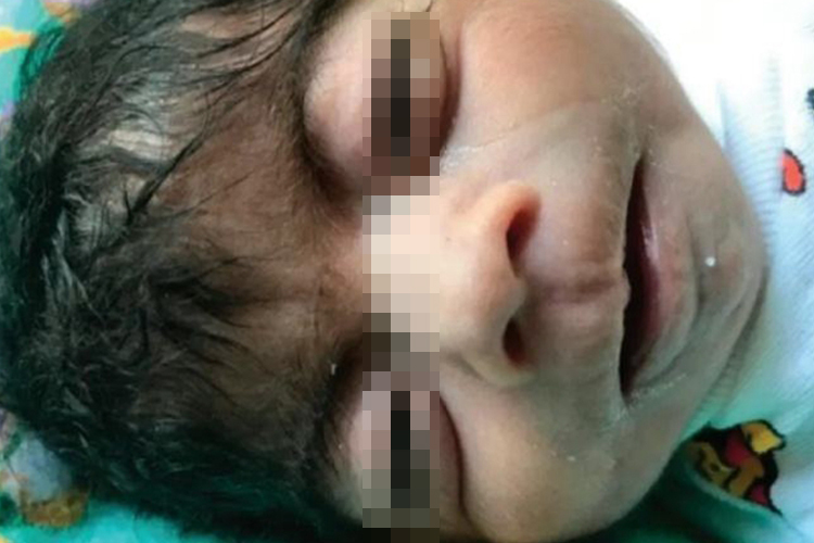 德朗热综合征轻微图