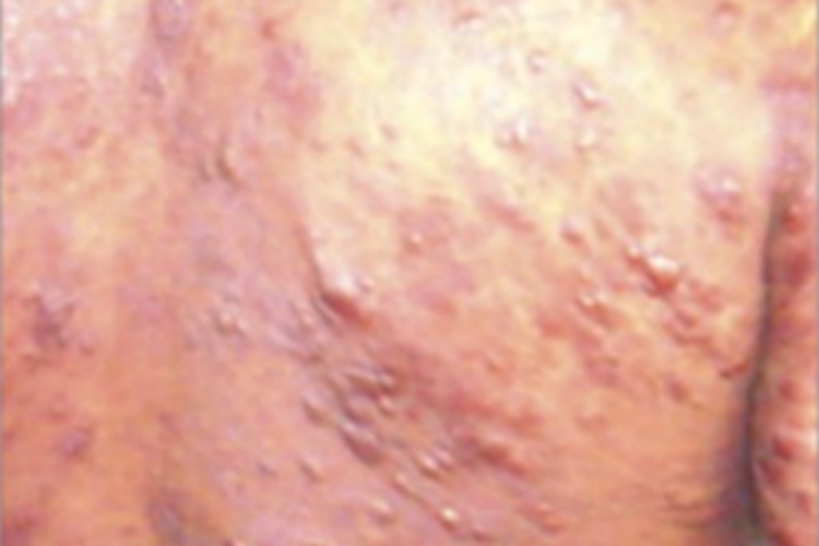 皮肤利什曼病背部结节图