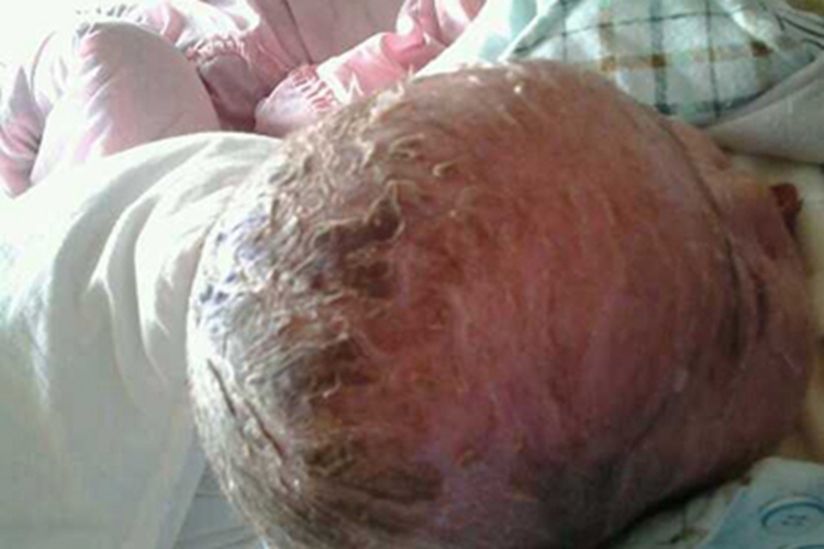 板层状鱼鳞病头皮黑痂图 板层状鱼鳞病头皮黑痂图