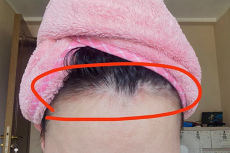 成人脂溢性皮炎前额红斑图 成人脂溢性皮炎前额红斑图