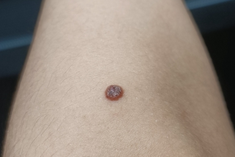 角化棘皮瘤胳膊小疙瘩图