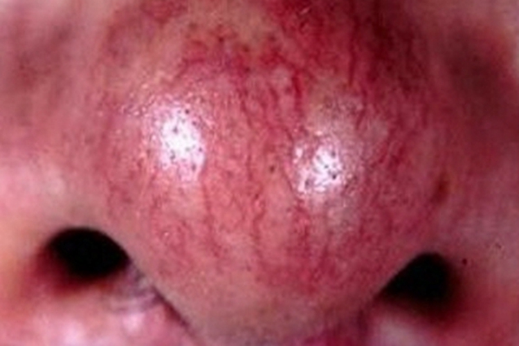 酒糟鼻血丝图 酒糟鼻血丝图