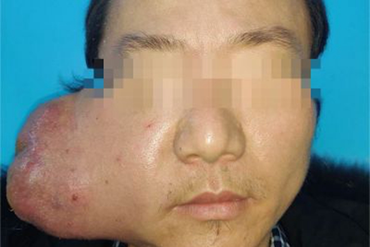 腮腺癌面部症状图