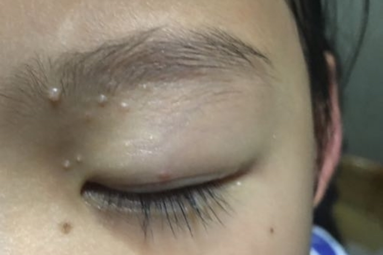 粟丘疹-眼皮上长了个小肉粒图