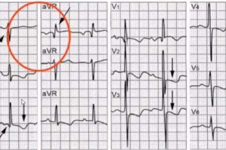 SⅠQⅢTⅢ型心电图