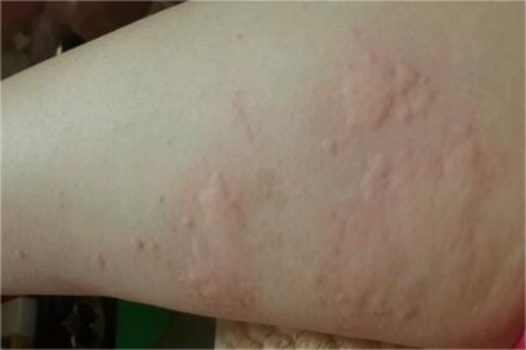 慢性自发性荨麻疹风团图 慢性自发性荨麻疹风团图