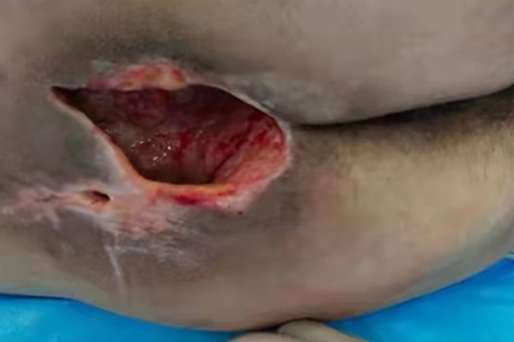 压疮臀部溃疡图