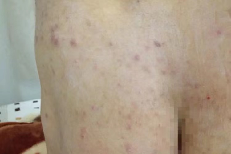 屁股上的痤疮图