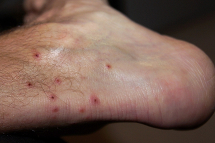 恙螨皮炎脚踝小红疙瘩图