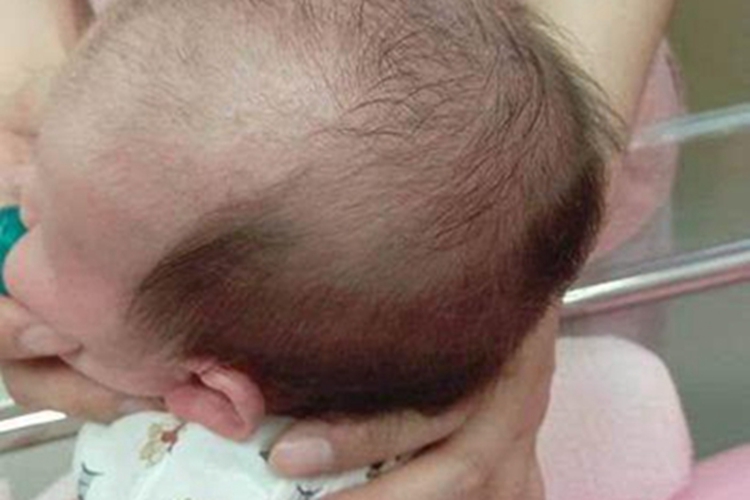 少毛症头发稀少发黄图