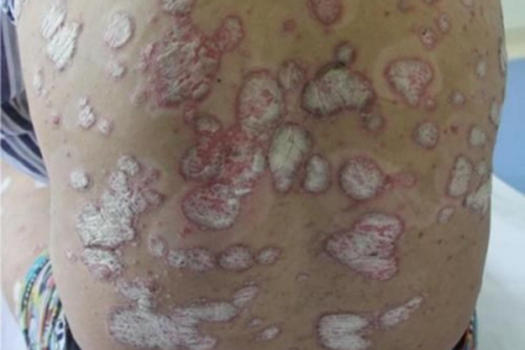 斑块型副银屑病症状图 斑块型副银屑病症状图