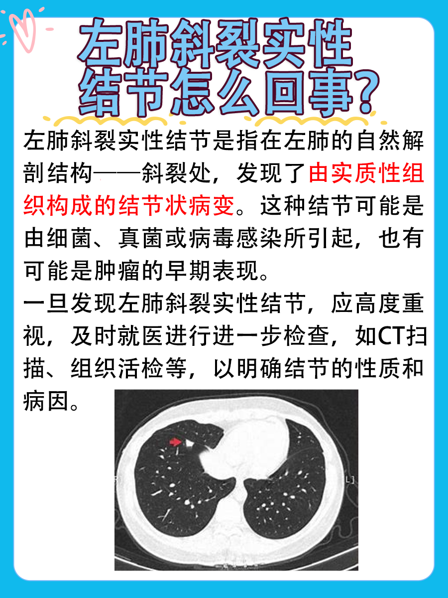 一文带你了解：左肺斜裂实性结节什么意思？