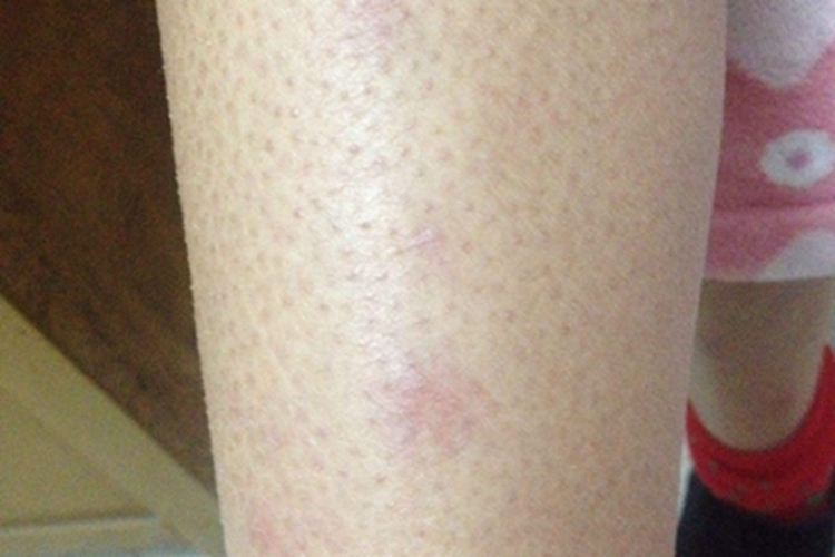 结节性液化性脂膜炎斑图 结节性液化性脂膜炎斑图