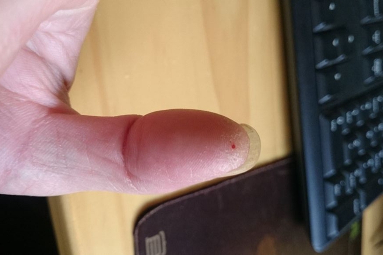 刺伤手指出血图