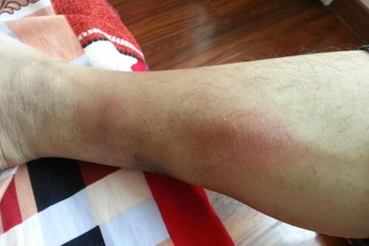 结节性红斑小腿红斑图